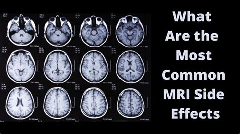 the villages mri side effects